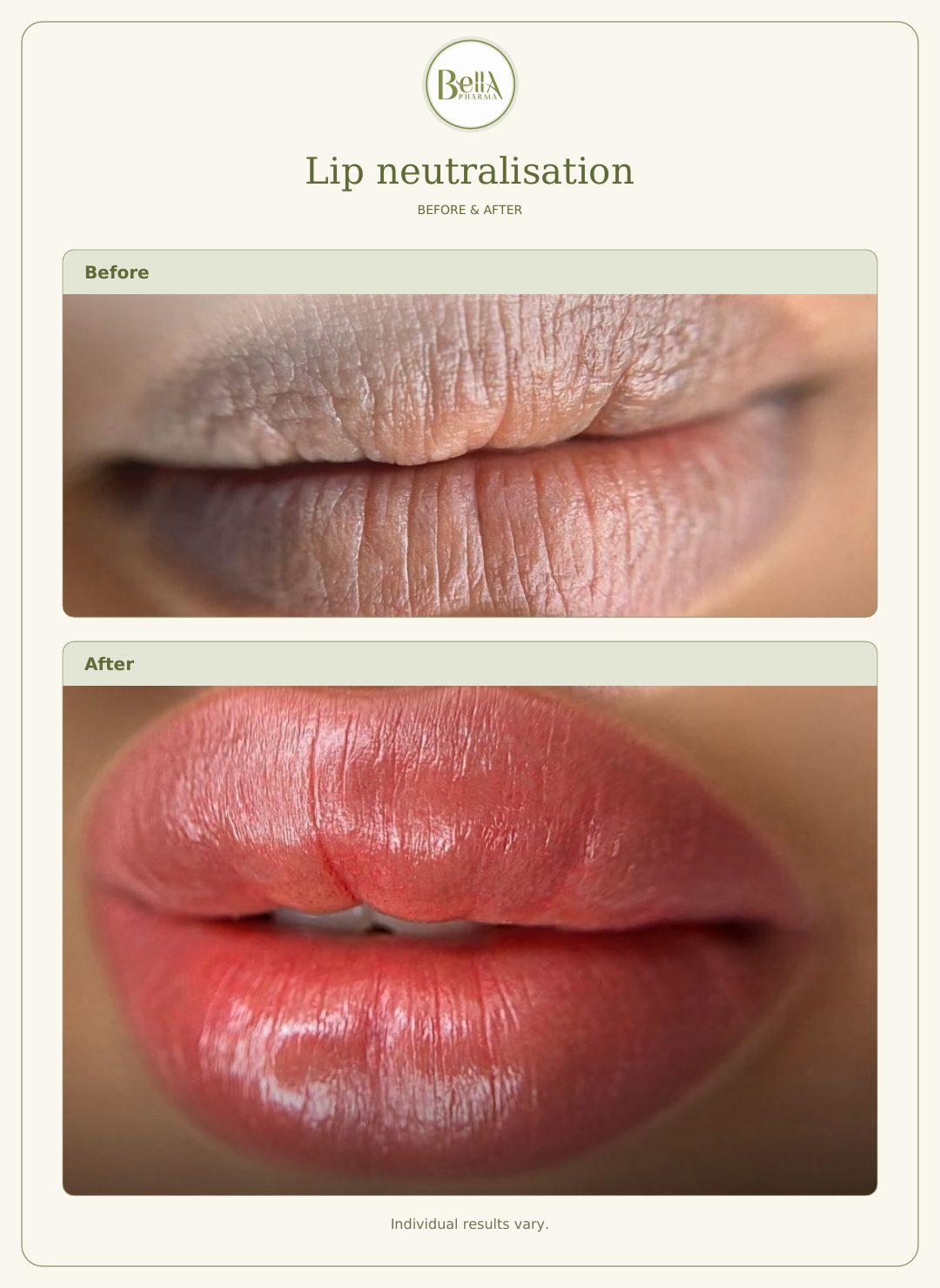 Client lip neutralisation example, before above and after below.