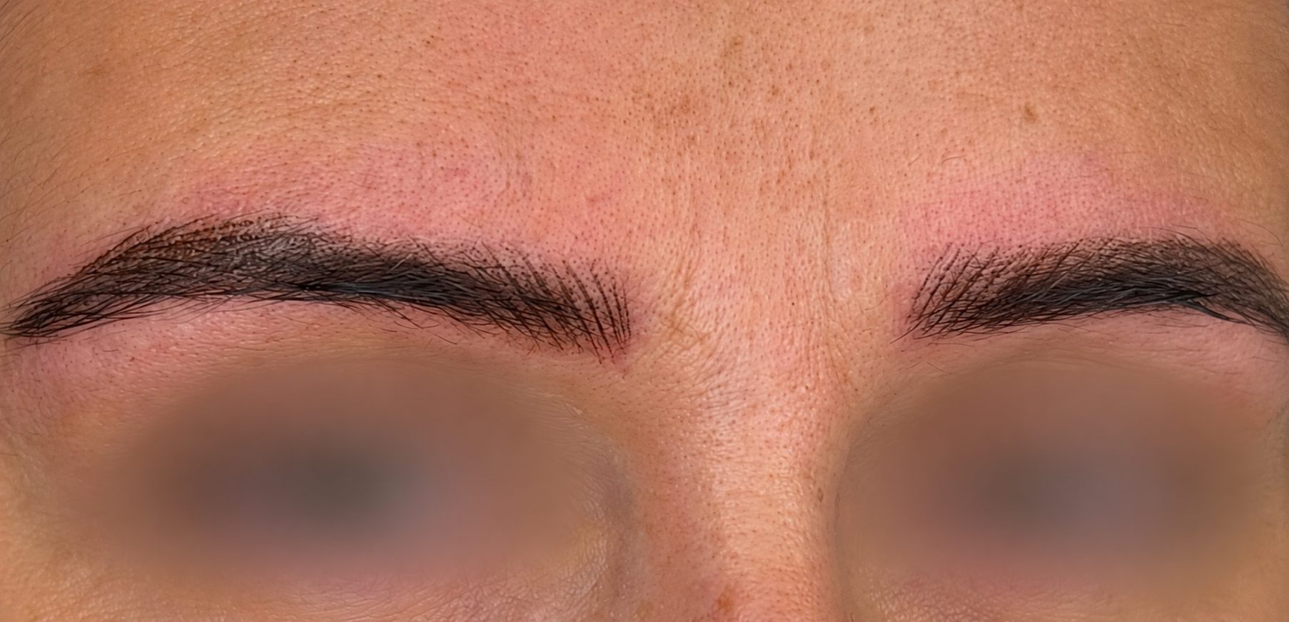 Immediately After · Angled View microblading at BellaPharma, eyes obscured for privacy