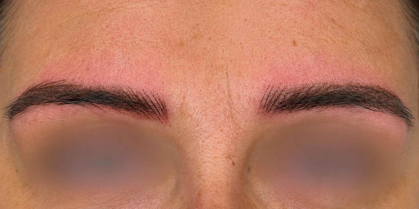 Immediately After · Front View microblading at BellaPharma, eyes obscured for privacy