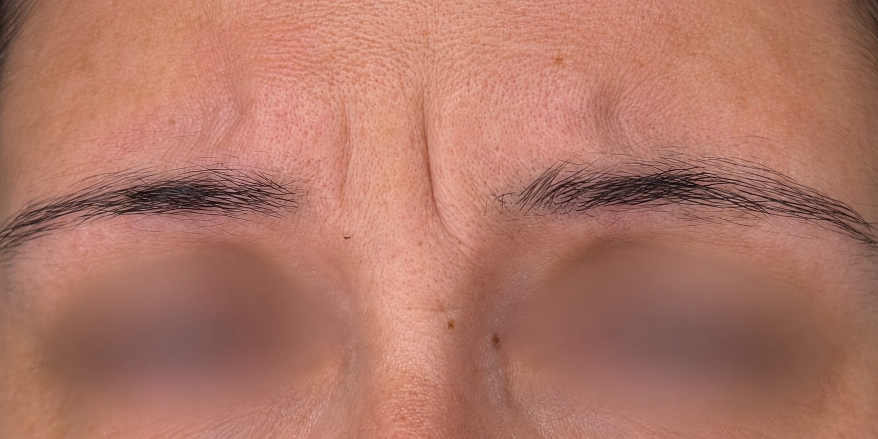 Before · Angled View microblading at BellaPharma, eyes obscured for privacy