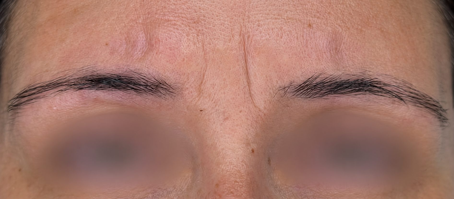 Before · Front View microblading at BellaPharma, eyes obscured for privacy